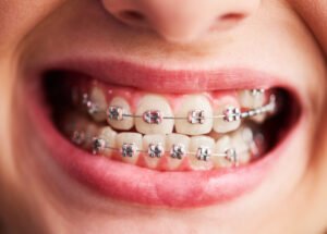 Braces Treatment
